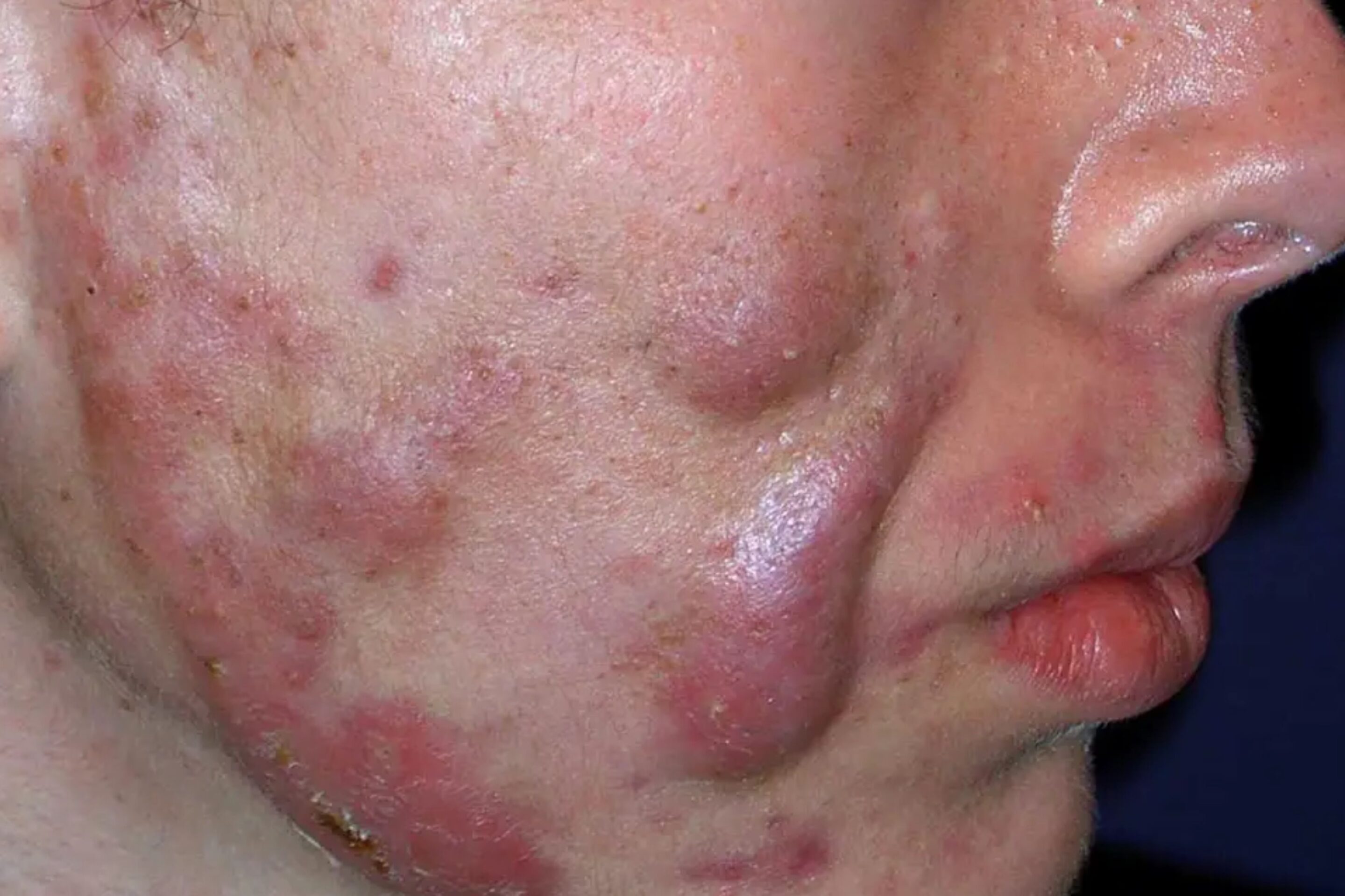 severe acne
