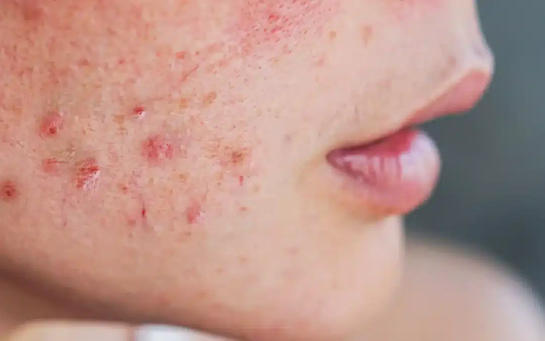 Acne: What Causes It And How To Get Rid Of It!