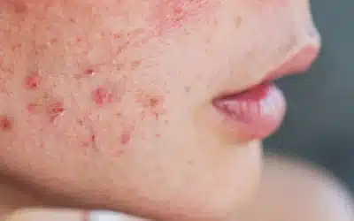 Acne: What Causes It And How To Get Rid Of It!