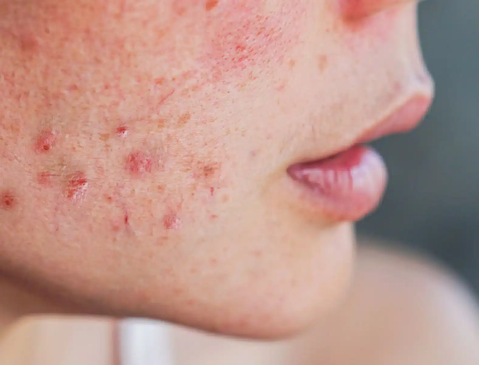 Hormonal Acne