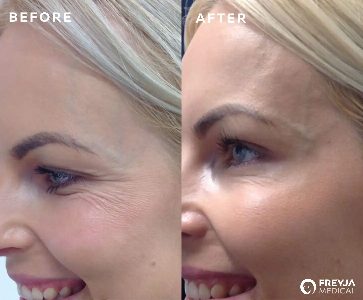 Anti-Wrinkle Treatment for Crows Feet at Freyja Medical. Before and After Image Anti-Wrinkle Injections / Regulated Botox in Wrexham and Nantwich