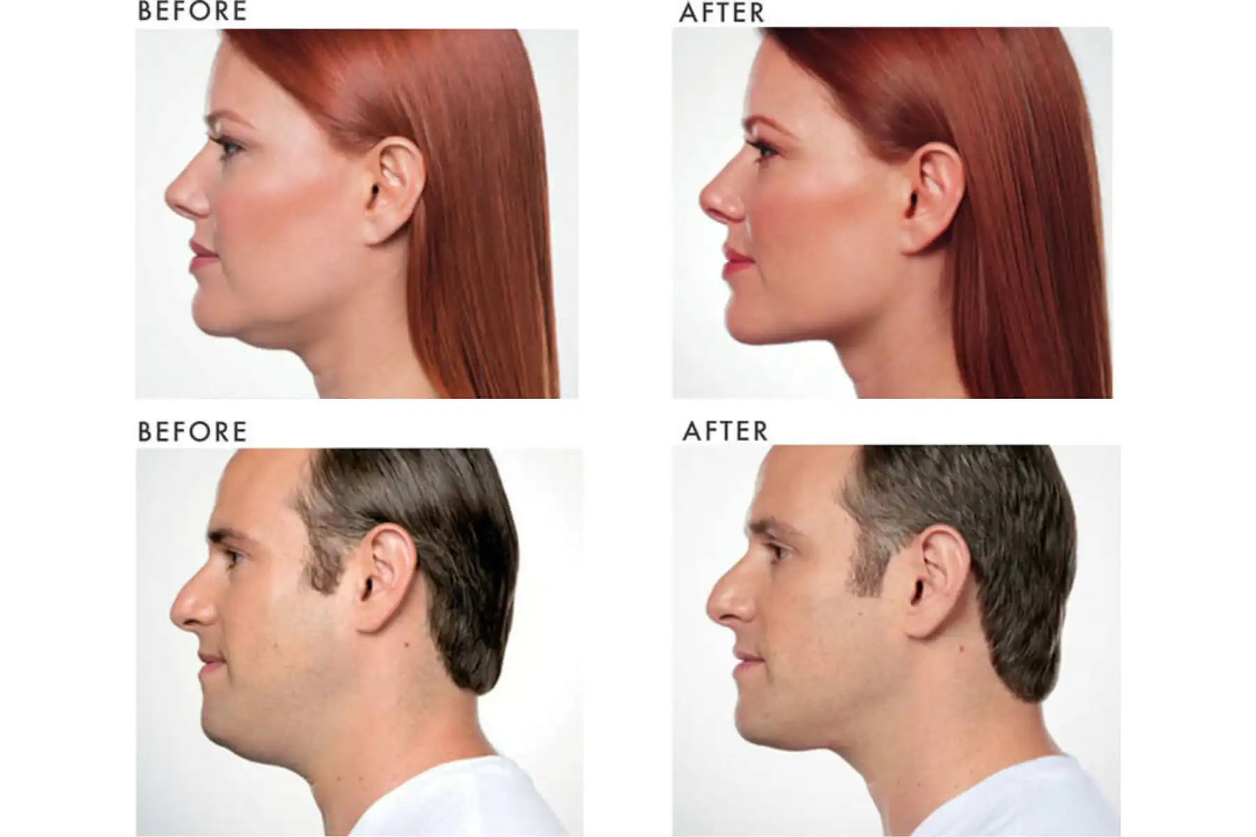 Aqualyx Fat Dissolving Injections before and after image