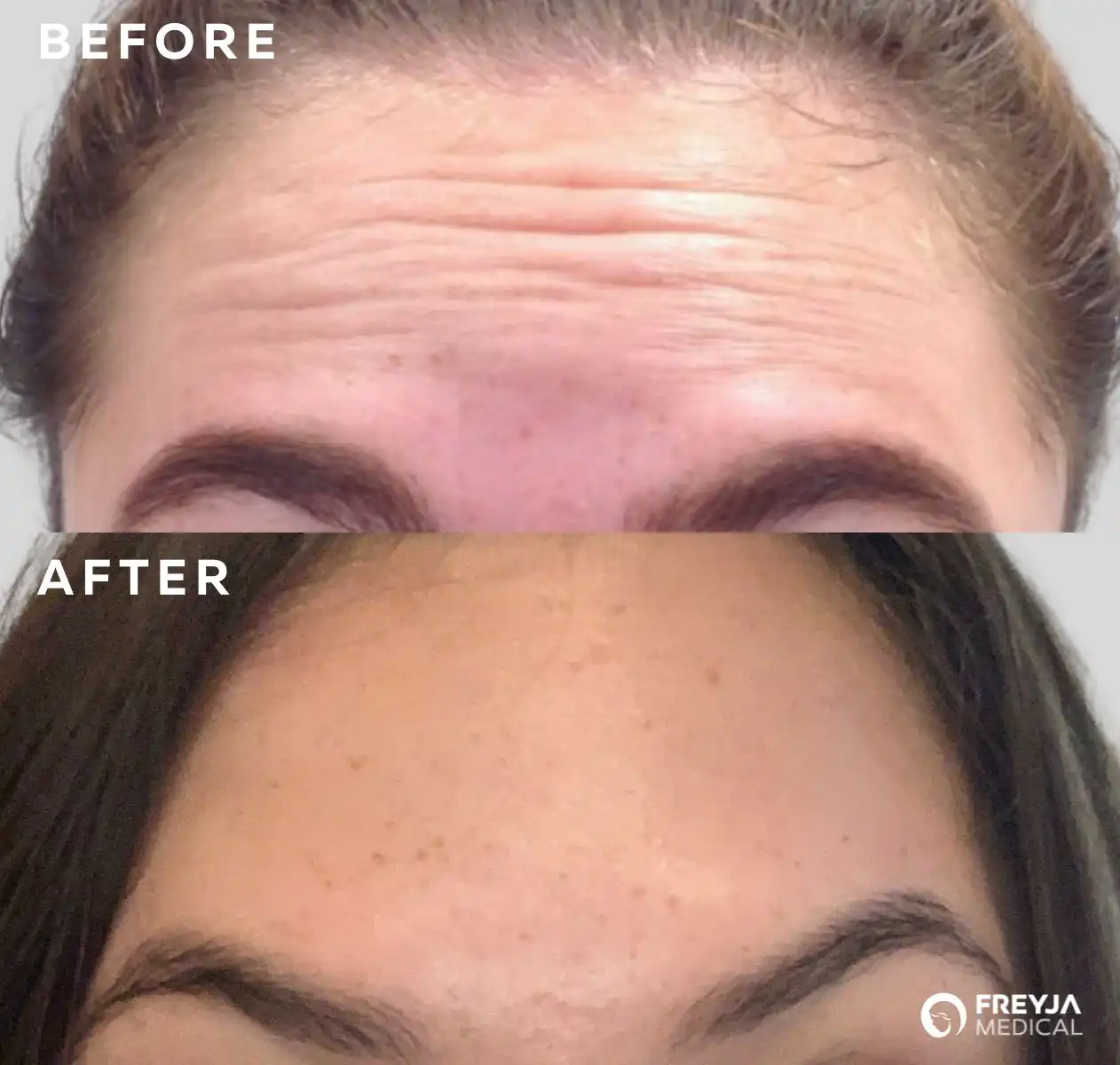 Before and After, anti-wrinkle treatment for forehead lines Anti-Wrinkle Injections / Regulated Botox in Wrexham and Nantwich