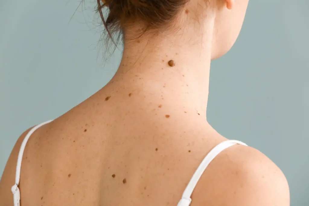 Benefits of Sunshine, Regular Mole Checks
