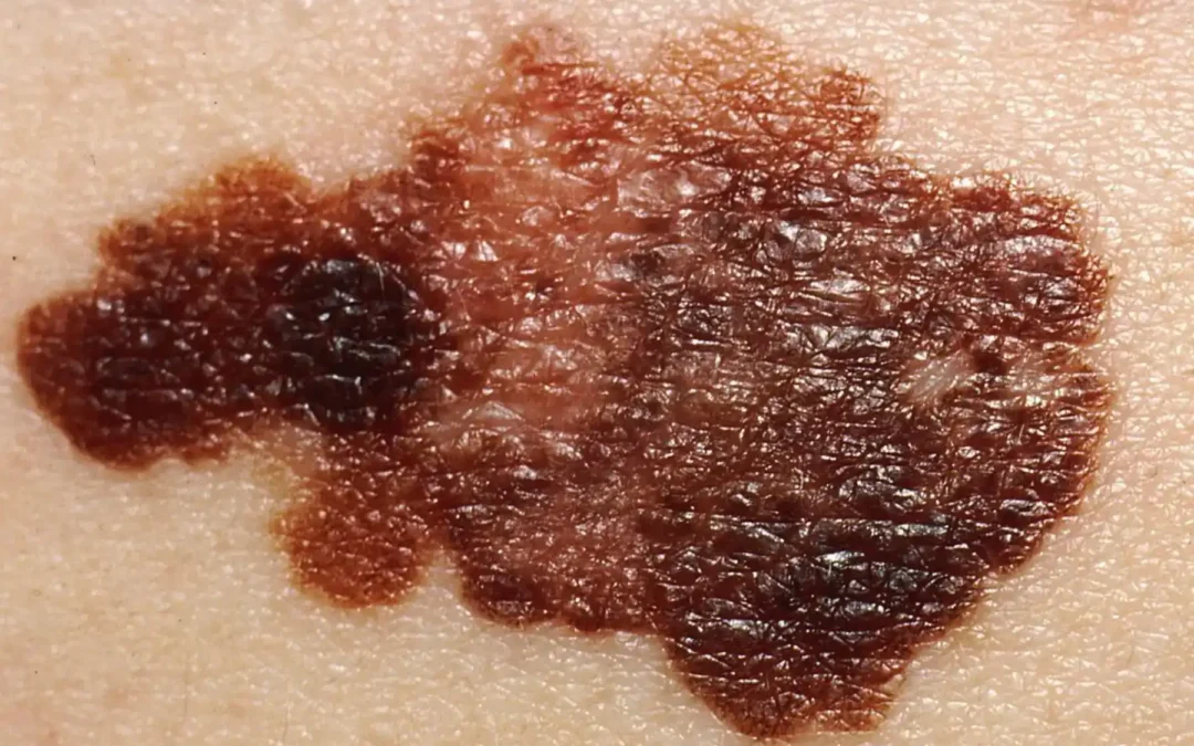 Skin Cancer Signs Symptoms: Types and Key Indicators