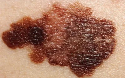 Skin Cancer Signs Symptoms: Types and Key Indicators