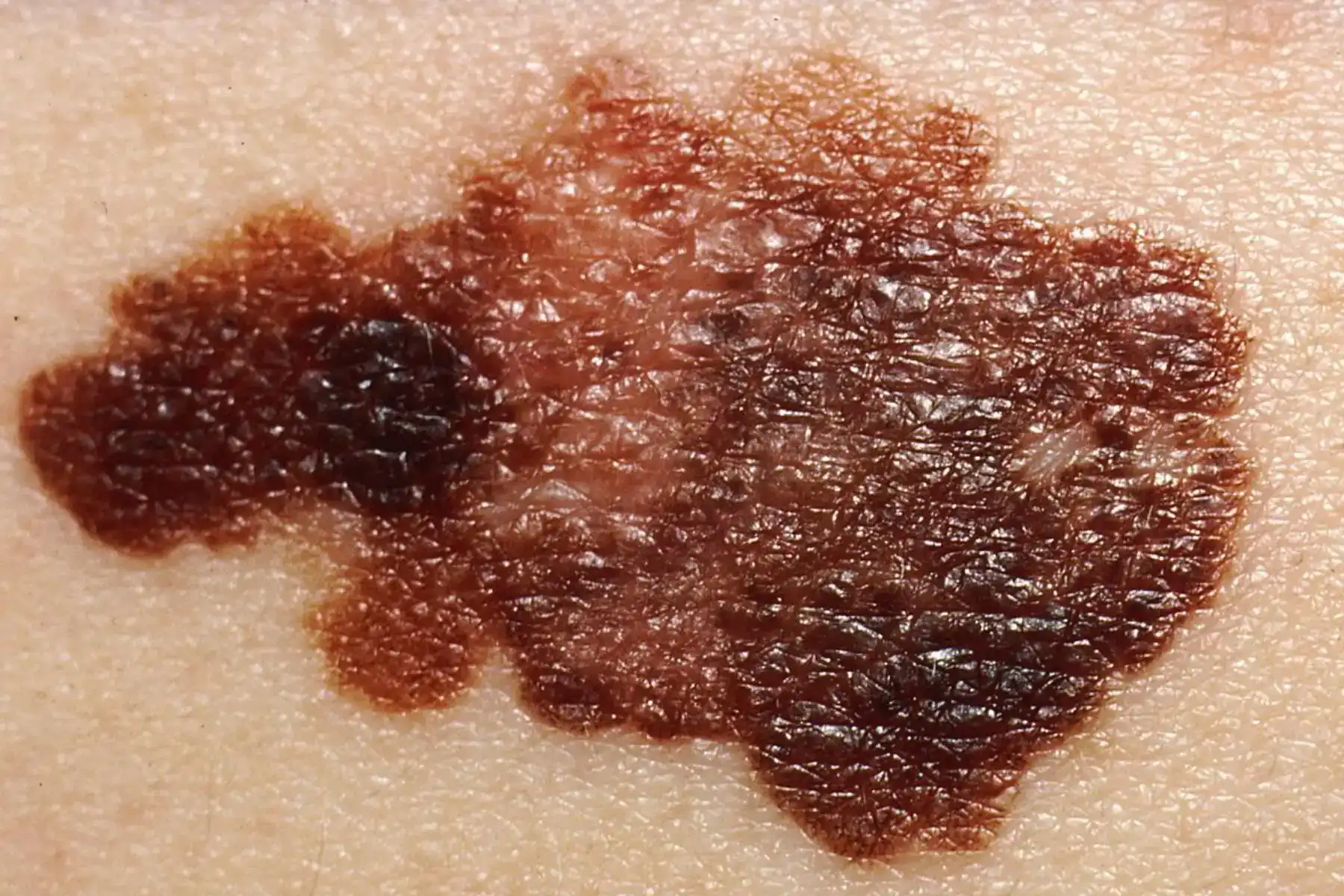 Conditions: Melanoma