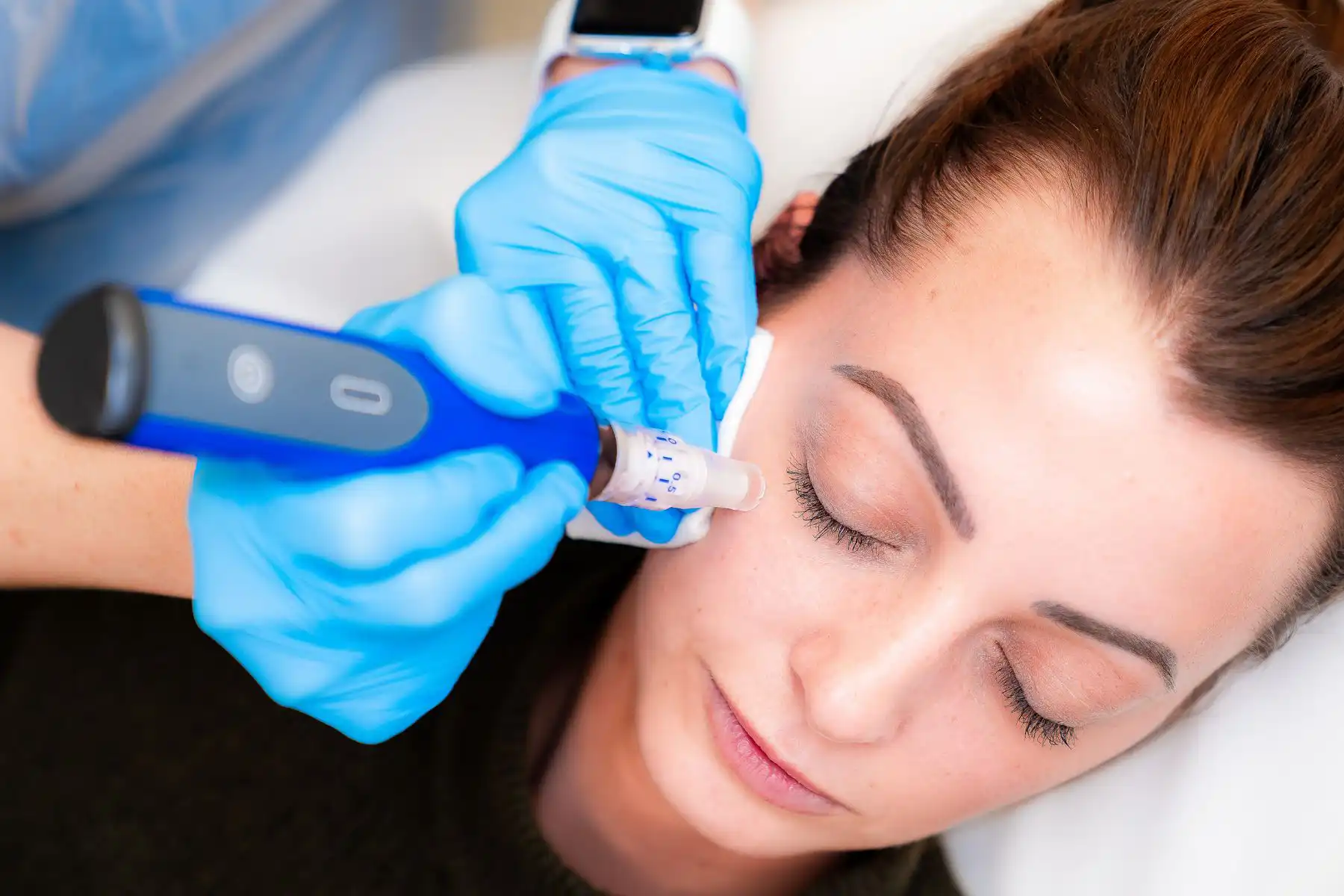 Fillers & Complementary Aesthetic Treatments: Microneedling