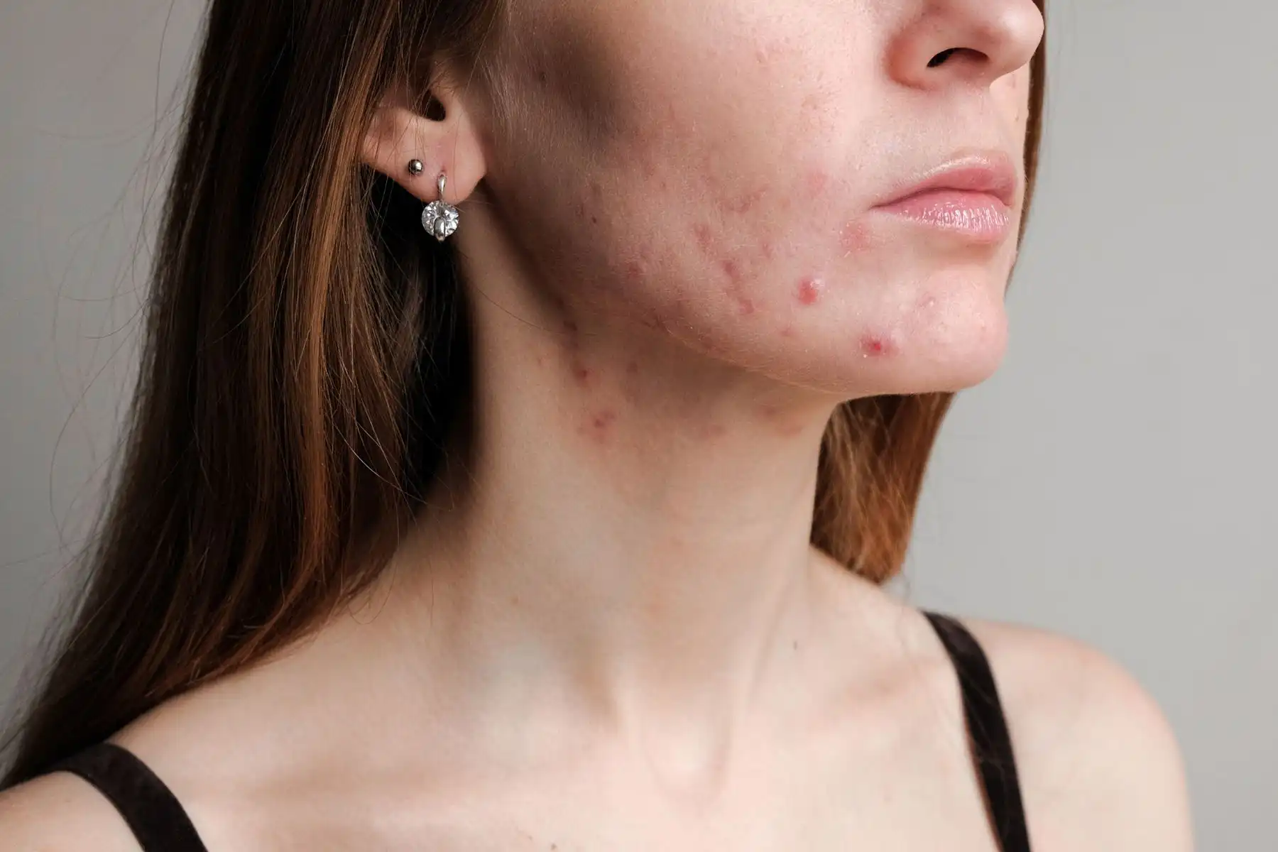 Hormonal Acne