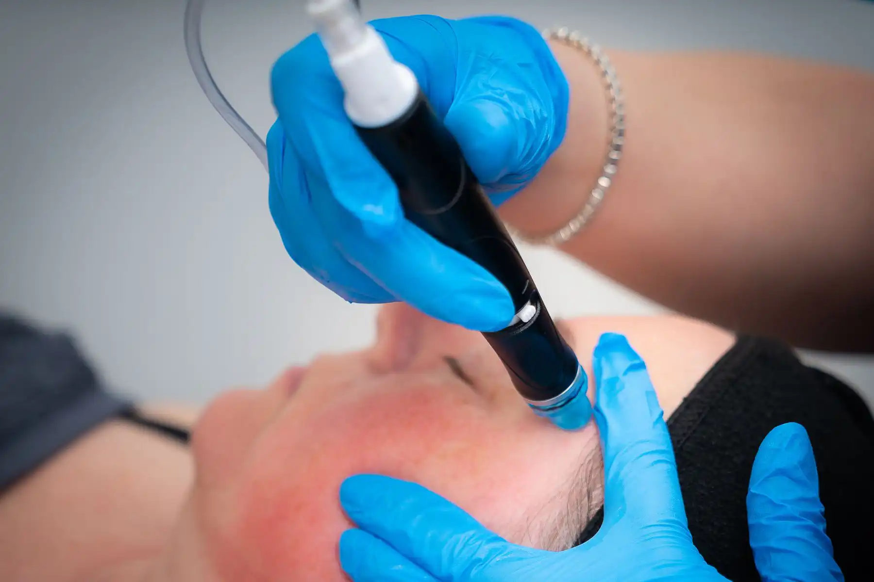 Hydrafacial Treatment perfromed by skin therapist Hattie Klein at Freyja Medical Hydrafacial Treatment perfromed by skin therapist Hattie Klein at Freyja Medical
