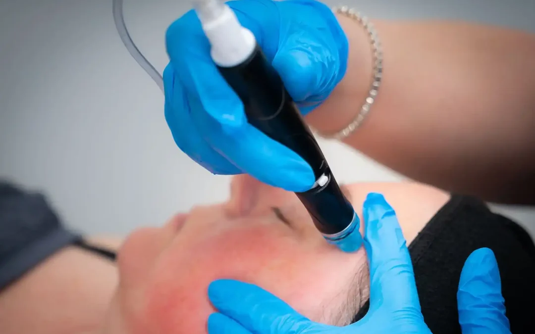 Hydrafacial vs Microdermabrasion – Which Is Better?