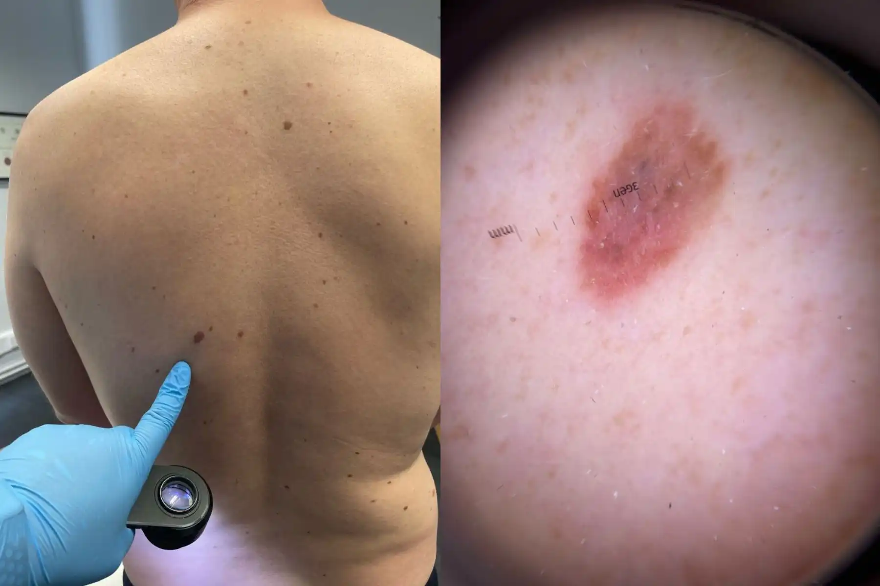 Mole Check