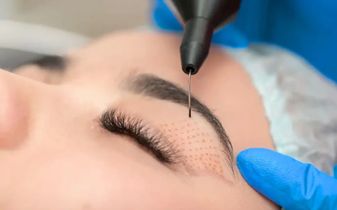 Introducing Plexr Plus: Non-Surgical Skin Tightening