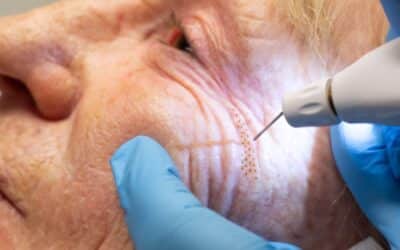 Introducing Plexr Plus: Non-Surgical Skin Tightening