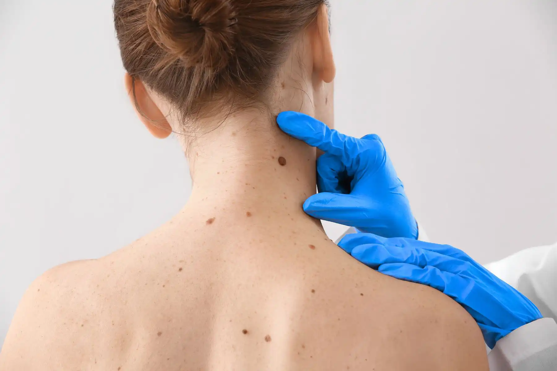 Professional Mole Checks at Freyja Medical Professional Mole Checks at Freyja Medical