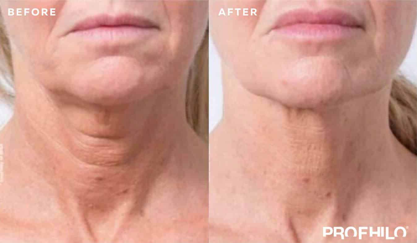 Profhilo before and after