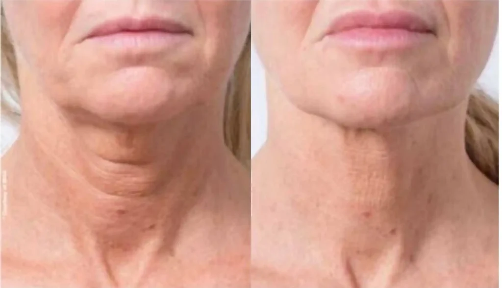 Profhilo before and after
