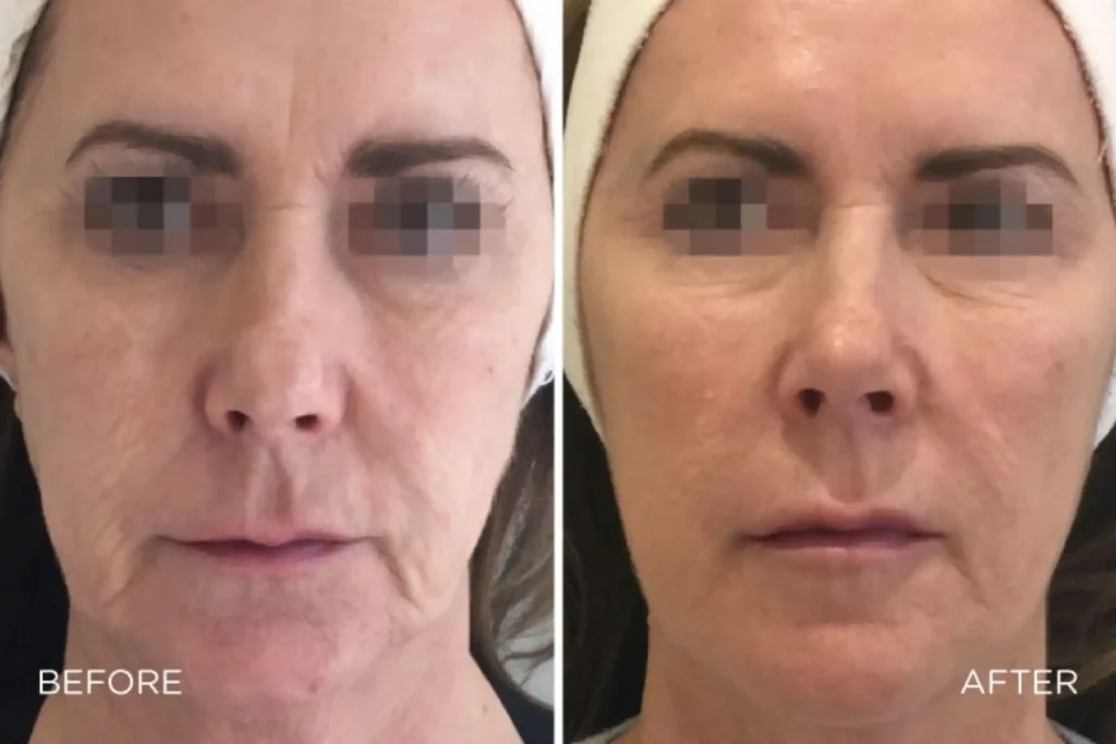Profhilo before and after