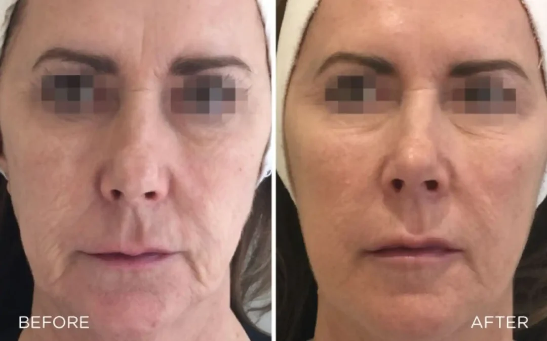 Profhilo Treatment In Nantwich