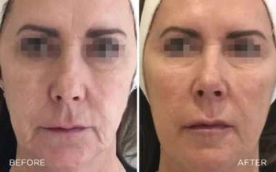 Profhilo Treatment In Nantwich