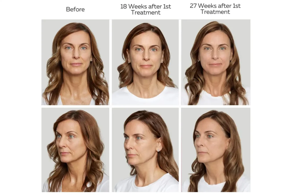 Sculptra for face and body