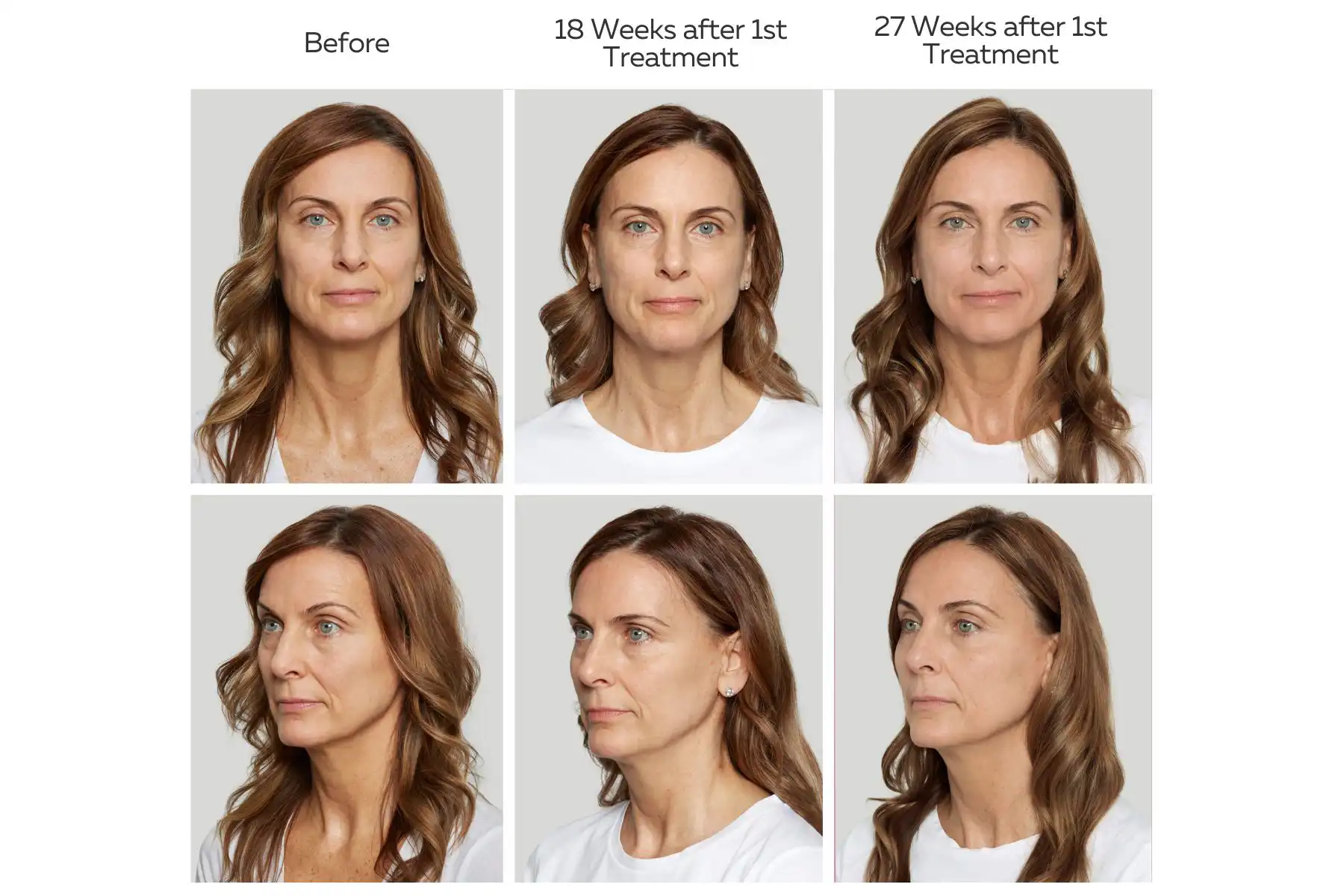 Sculptra for face and body