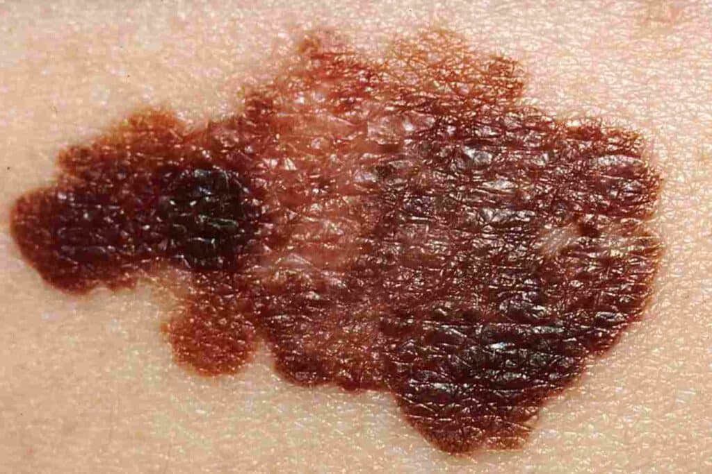 Signs of a Melanoma, Freyja Medical