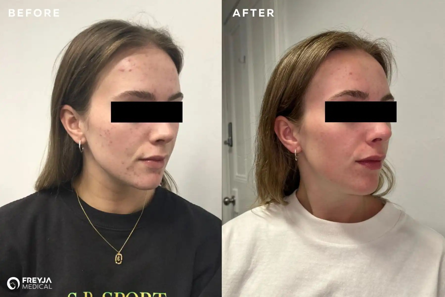 Skin Peel Treatment for Acne: Before and After