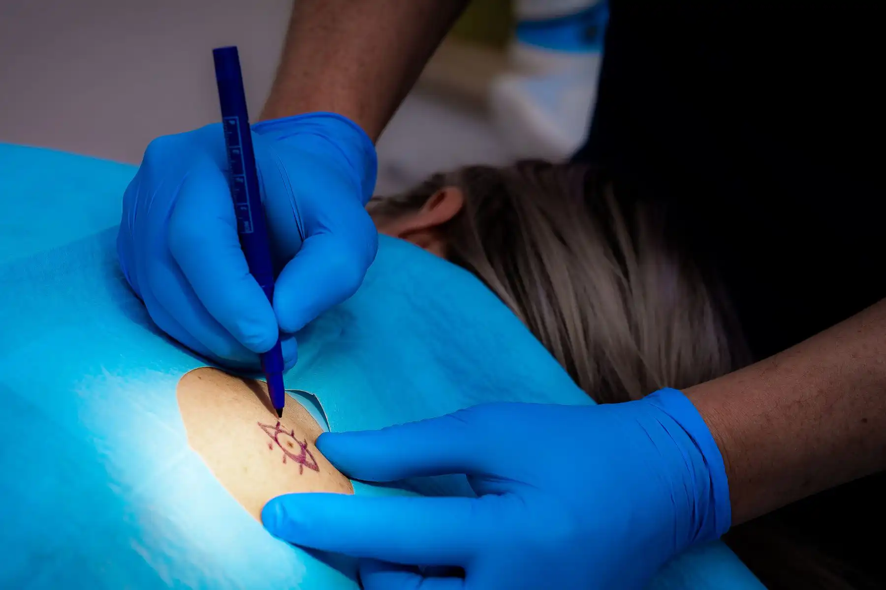Skin Surgery and Mole Removal at Freyja Medical Skin Surgery and Mole Removal at Freyja Medical