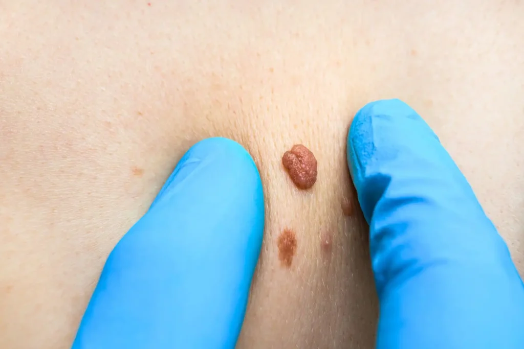 Skin Surgery at Freyja Medical: Mole Removal, Skin Tag Removal, Wart Removal