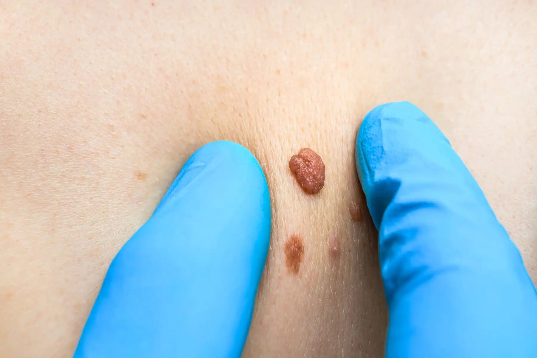 Skin Surgery at Freyja Medical: Mole Removal, Skin Tag Removal, Wart Removal and more Skin Surgery at Freyja Medical: Mole Removal, Skin Tag Removal, Wart Removal and more