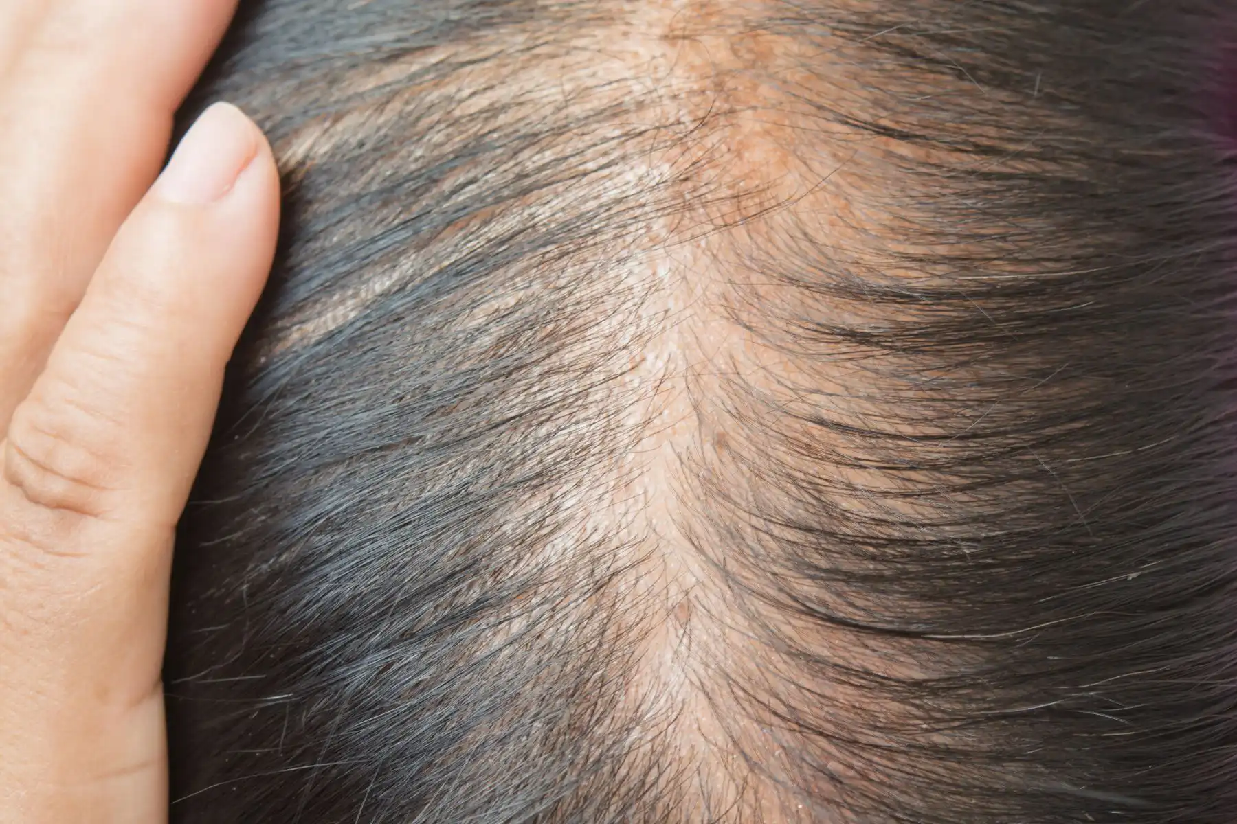 Thinning Hair Thinning Hair