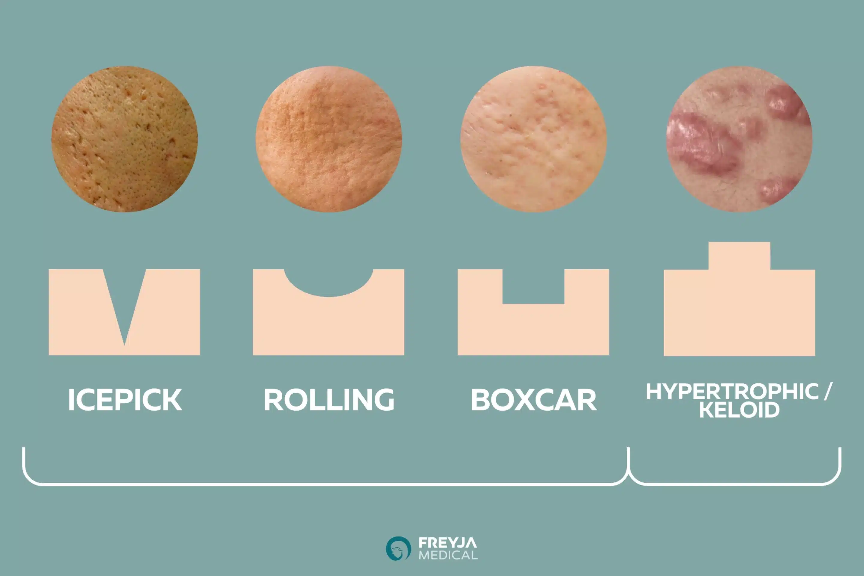 Types of Acne Scarring: Icepick, Rolling, Boxcar, Hypertrophic, Keloid