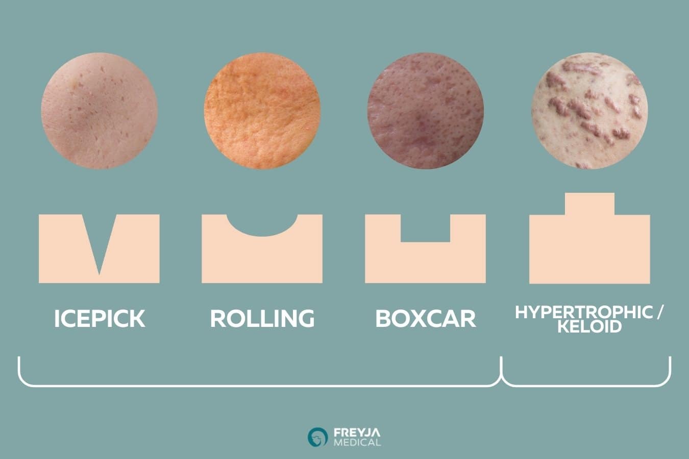 Types of Acne Scarring: Icepick, Rolling, Boxcar, Hypertrophic, Keloid