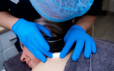 Mole Checks and Removal: Expert Insights