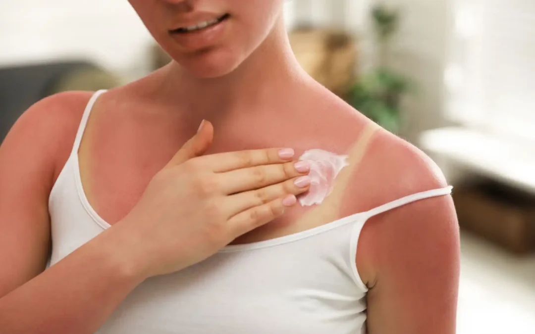 Treatments for Sunburn: How to Heal & Protect Skin