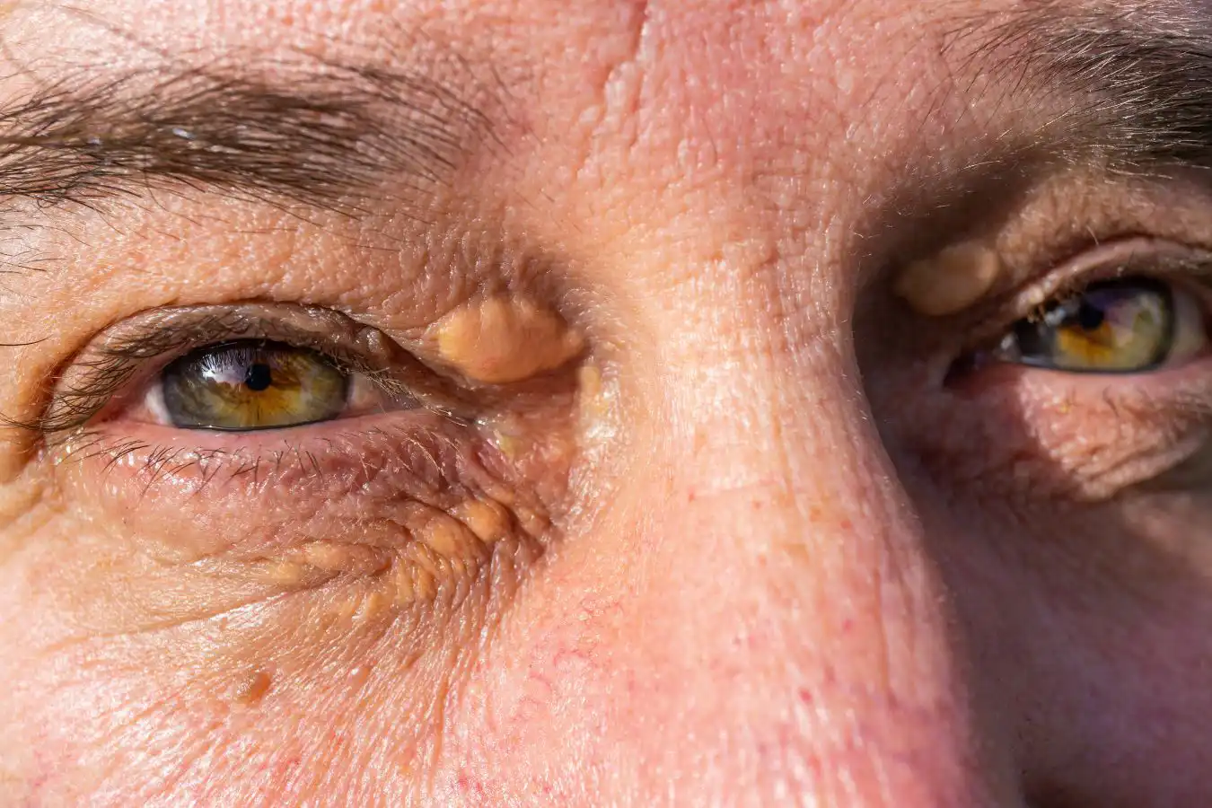 Xanthelasma