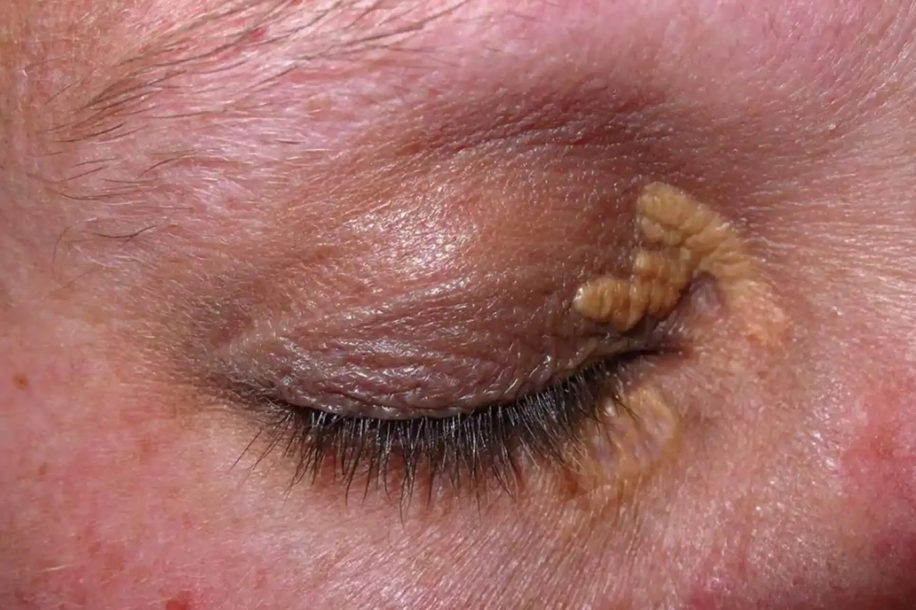 Xanthelasma
