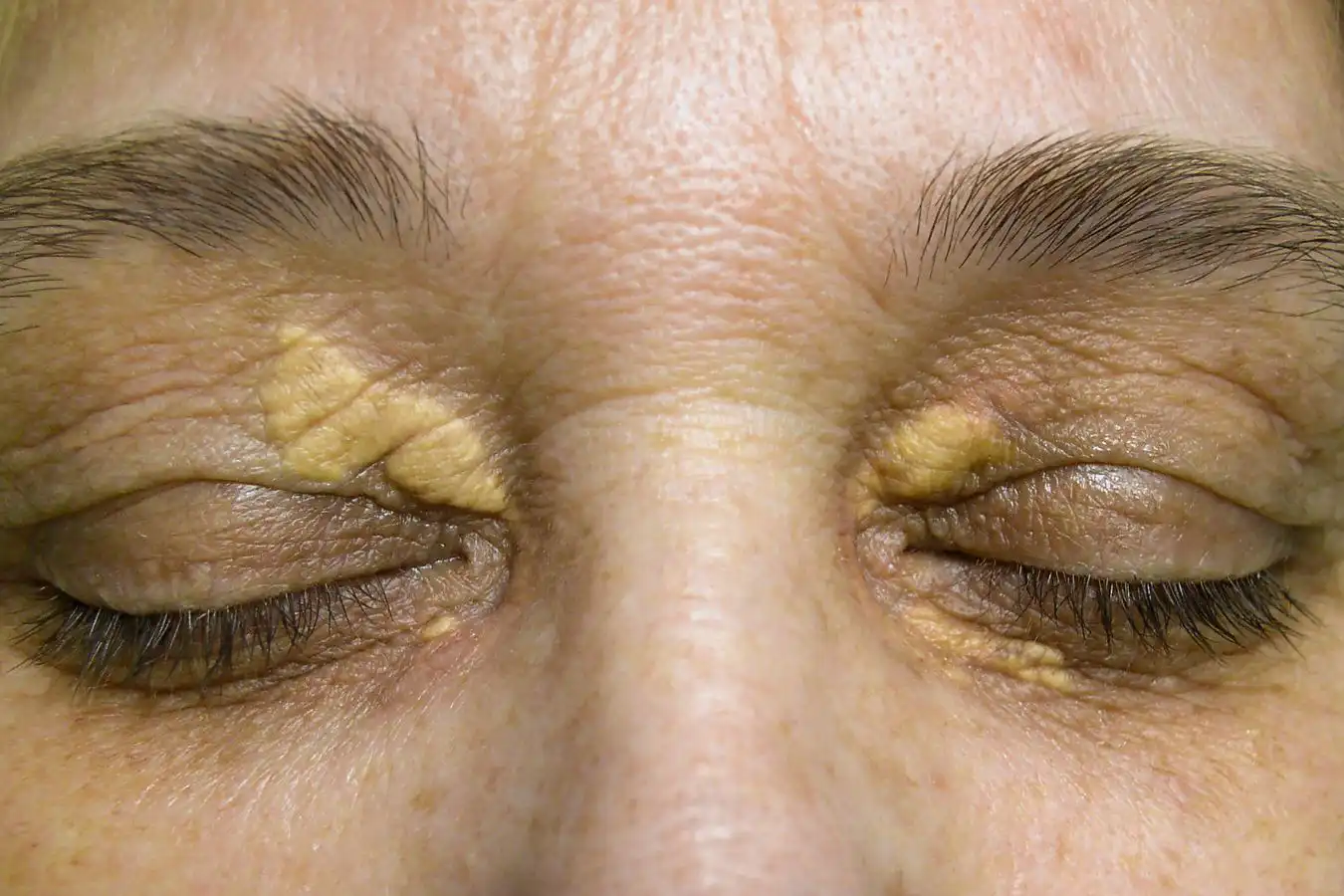 Xanthelasma