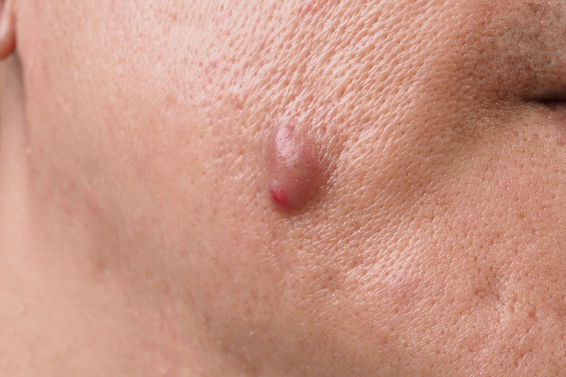 Psoriasis