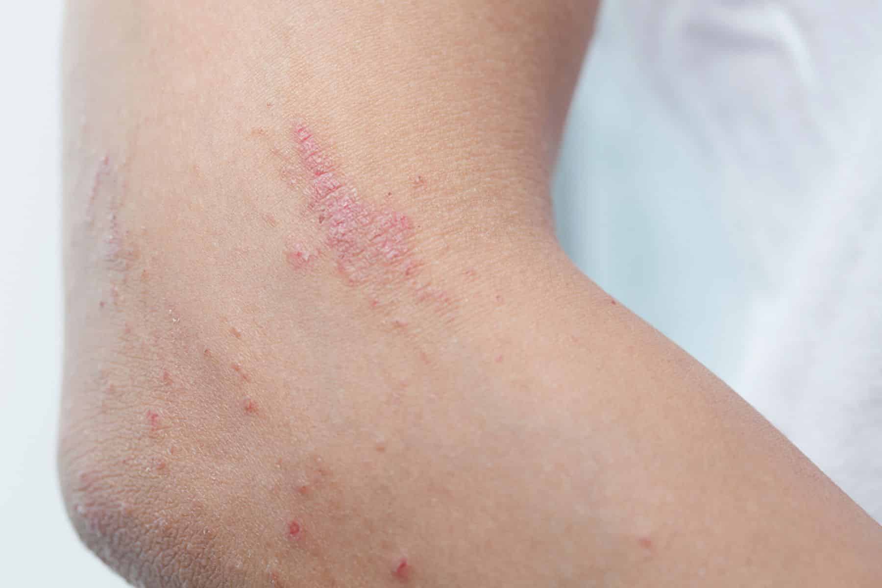 Psoriasis