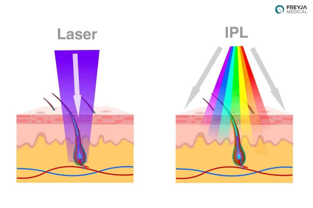 Diagram comparing laser and IPL showing how each targets hair follicles within the skin