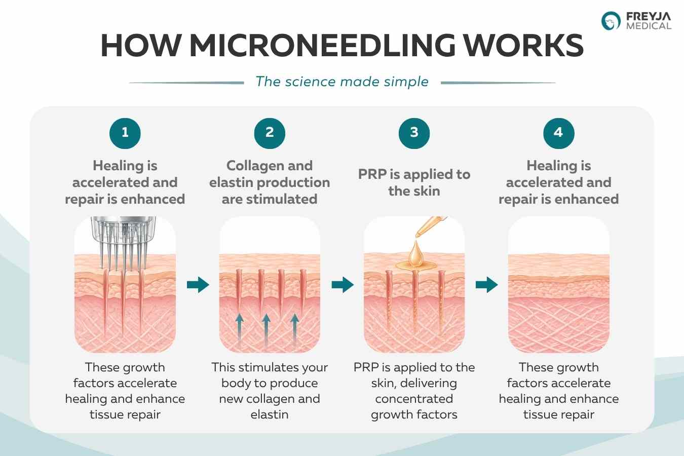 Infographic showing how microneedling works in four steps, including creating micro-injuries, stimulating collagen and elastin production, applying PRP, and accelerating skin healing and repair.