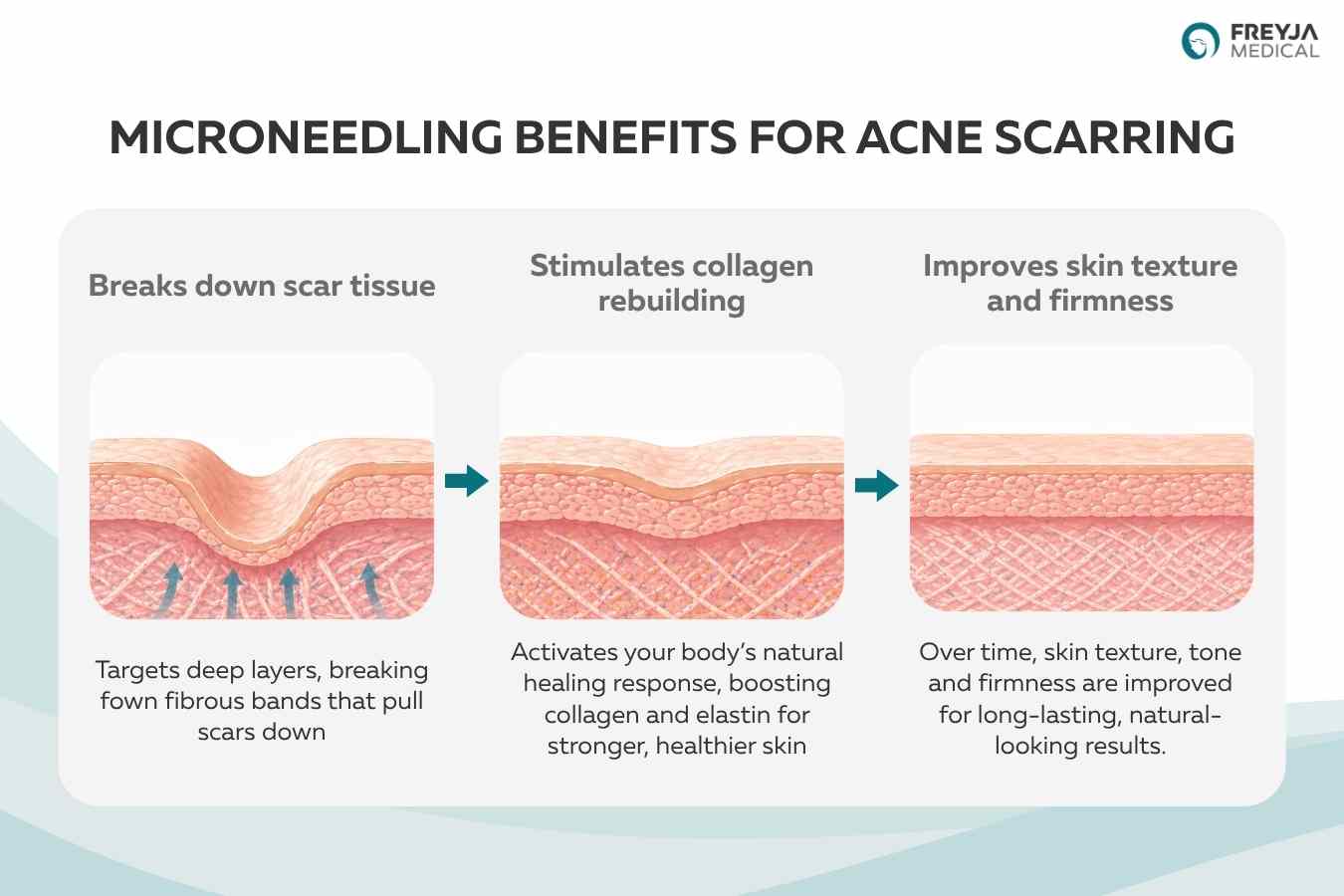 Infographic showing the benefits of microneedling for acne scarring, including breaking down scar tissue, stimulating collagen rebuilding, and improving skin texture and firmness.