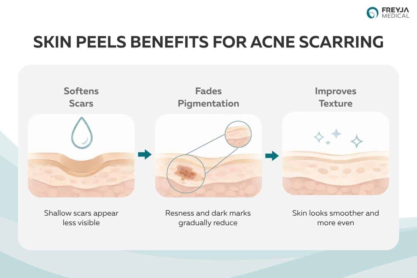 Infographic showing the benefits of skin peels for acne scarring, including softening scars, fading pigmentation, and improving overall skin texture.