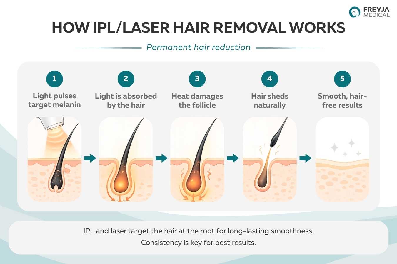 Illustrated diagram showing how IPL and laser hair removal works, from light targeting melanin in the hair follicle to heat damaging the follicle, hair shedding naturally, and achieving smooth, long-lasting hair reduction.