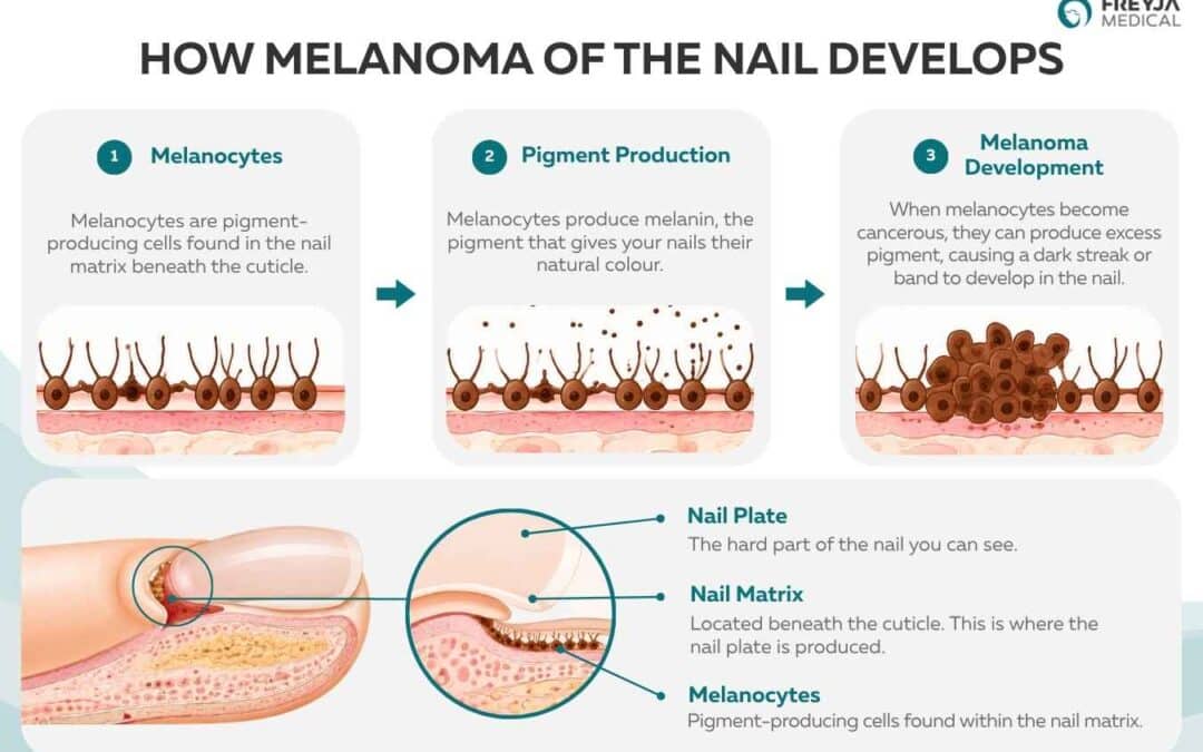 Melanoma of the Nail: Symptoms and Treatment