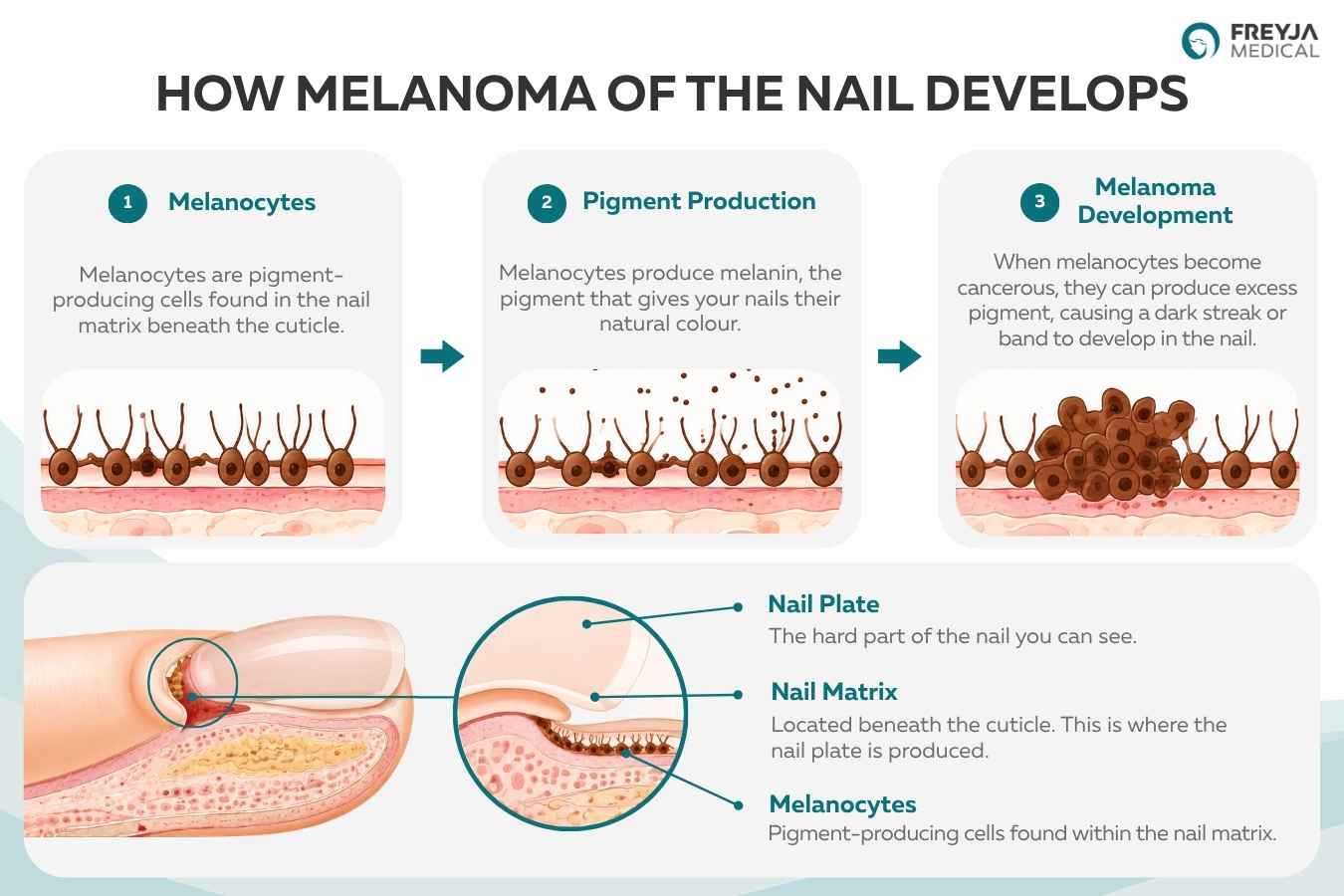 Infographic showing how melanoma of the nail develops from melanocytes in the nail matrix beneath the cuticle.