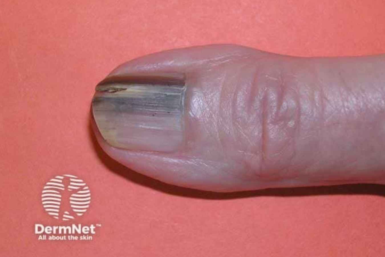 Melanoma of the nail causing a wide dark pigmented band across the fingernail.