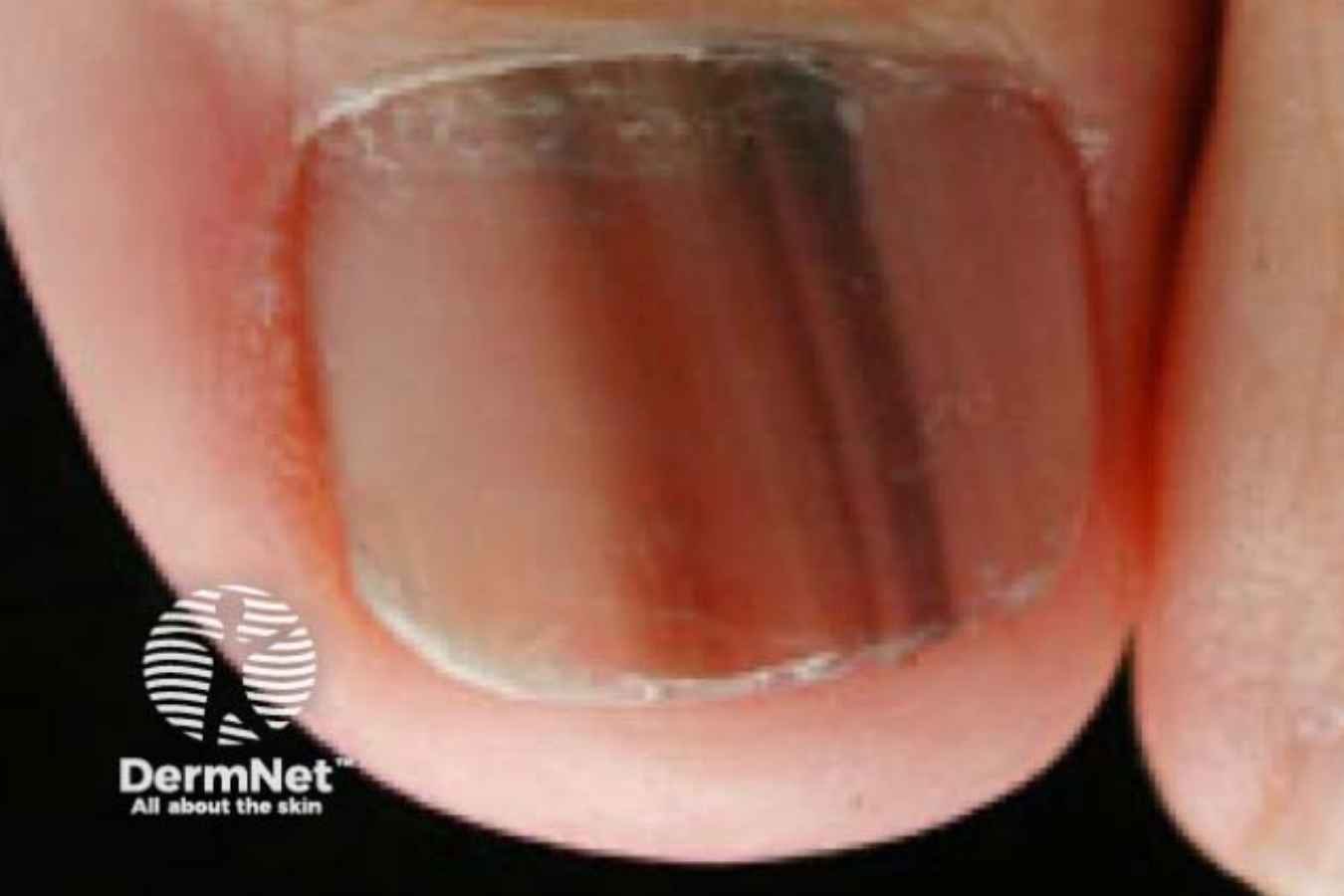Early melanoma of the nail showing a narrow brown vertical band beneath the thumbnail.